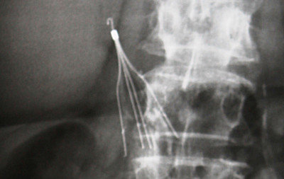 ivc filter retrieval x-ray
